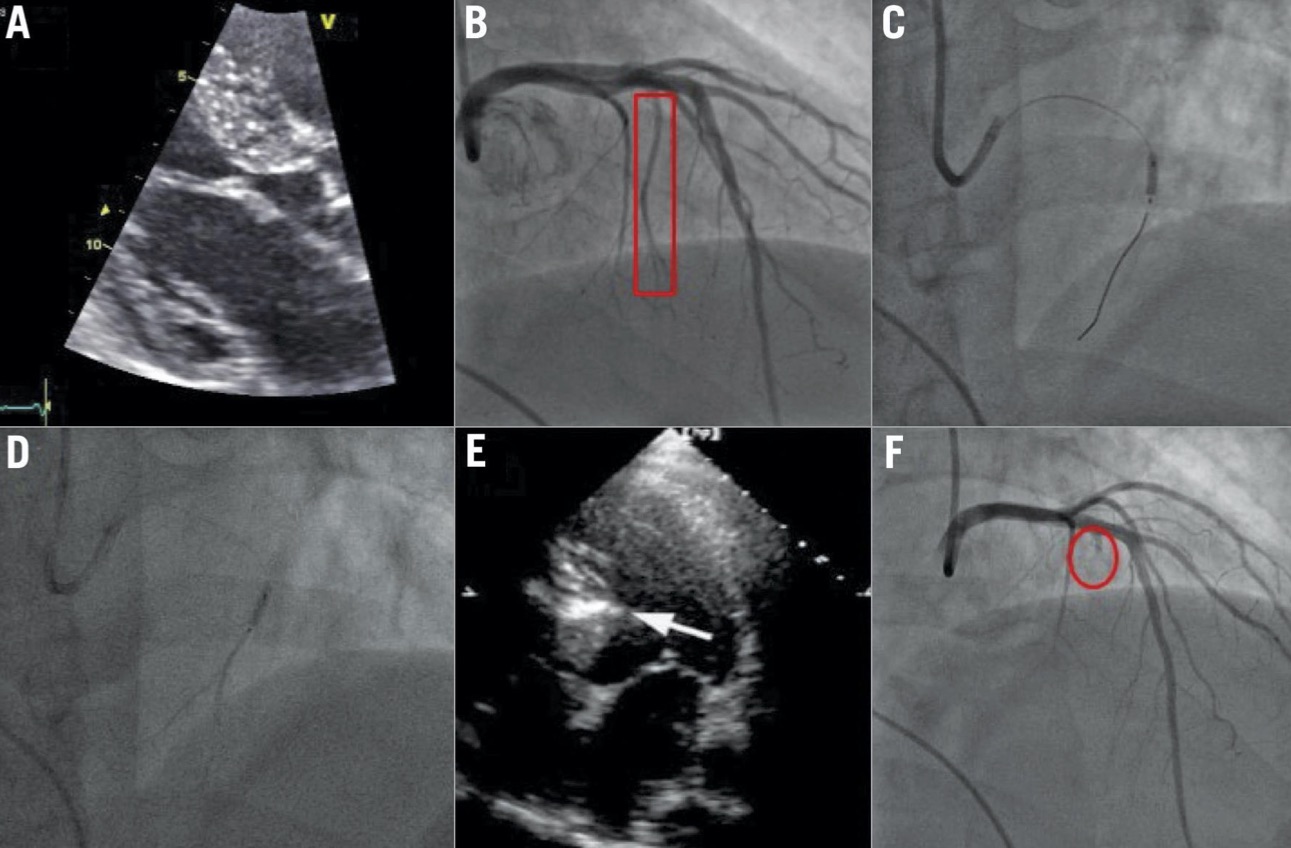 Percutaneous septal alcoholization