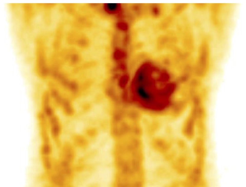 Cardiac Amyloidosis: TTR scintigraphy