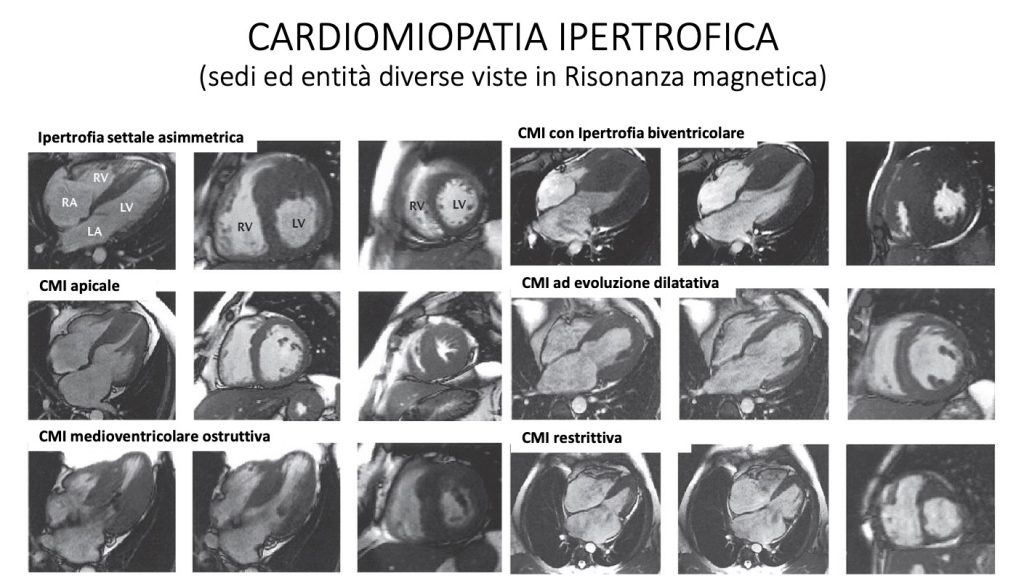 Hypertrophic Cardiomyopathy (different locations and entities seen in MRI)