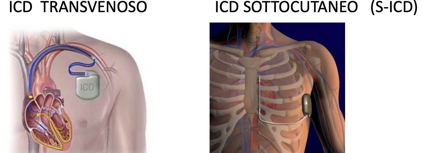 Implantable Defibrillators