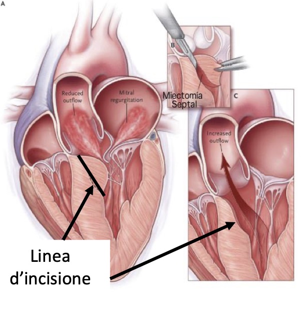 Myectomy-CMI-Obstructive