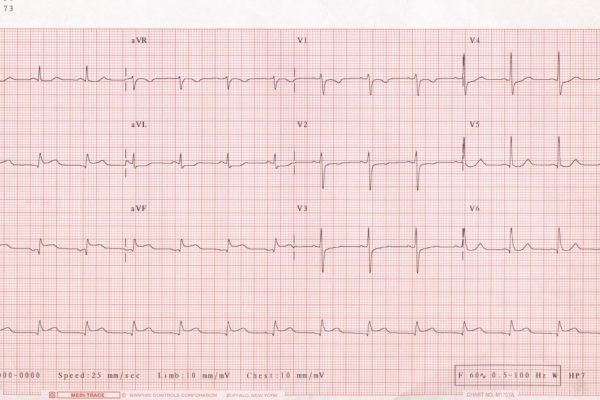 ecg progetto d-heart